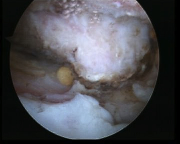 Shoulder Scope Large Acromial Spur